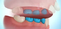Tongue Thrust Habit