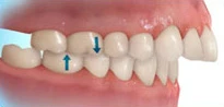Upper Front Teeth Protrusion
