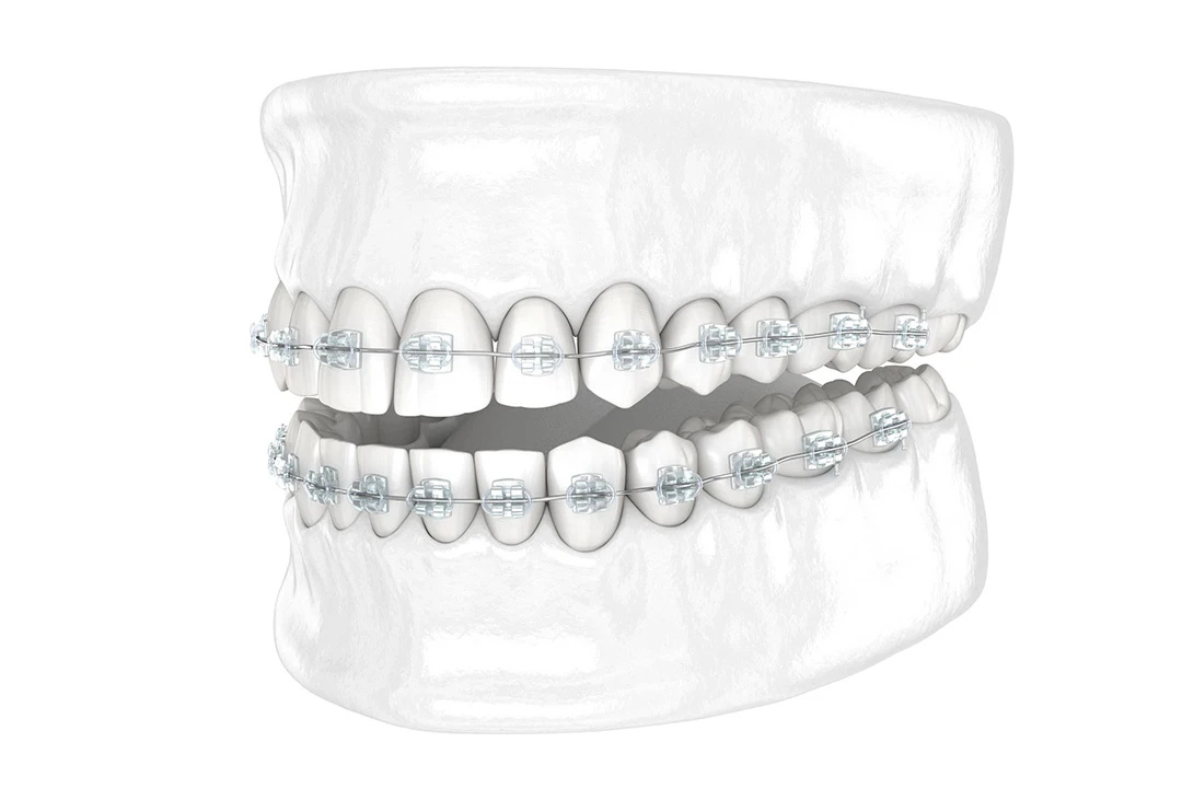 clear_braces_1
