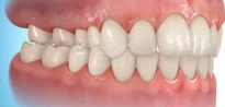 crossbite