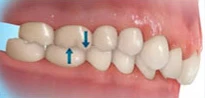 overbite