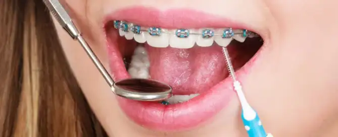 Top 5 Benefits of Getting Braces in Peoria, IL 1